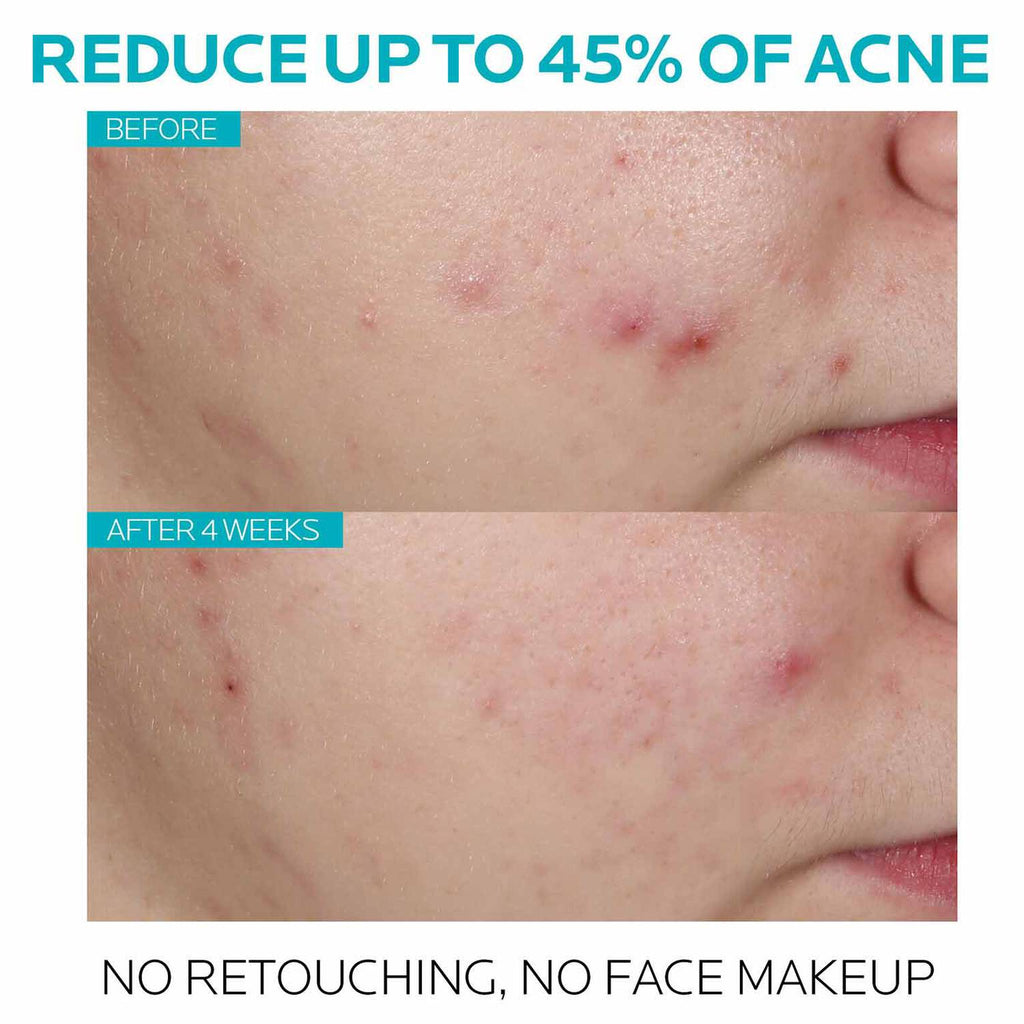 effaclar-salicylic-acid-acne-treatment-serum-b4 7_EffaclarSerum_After-45-days.jpg