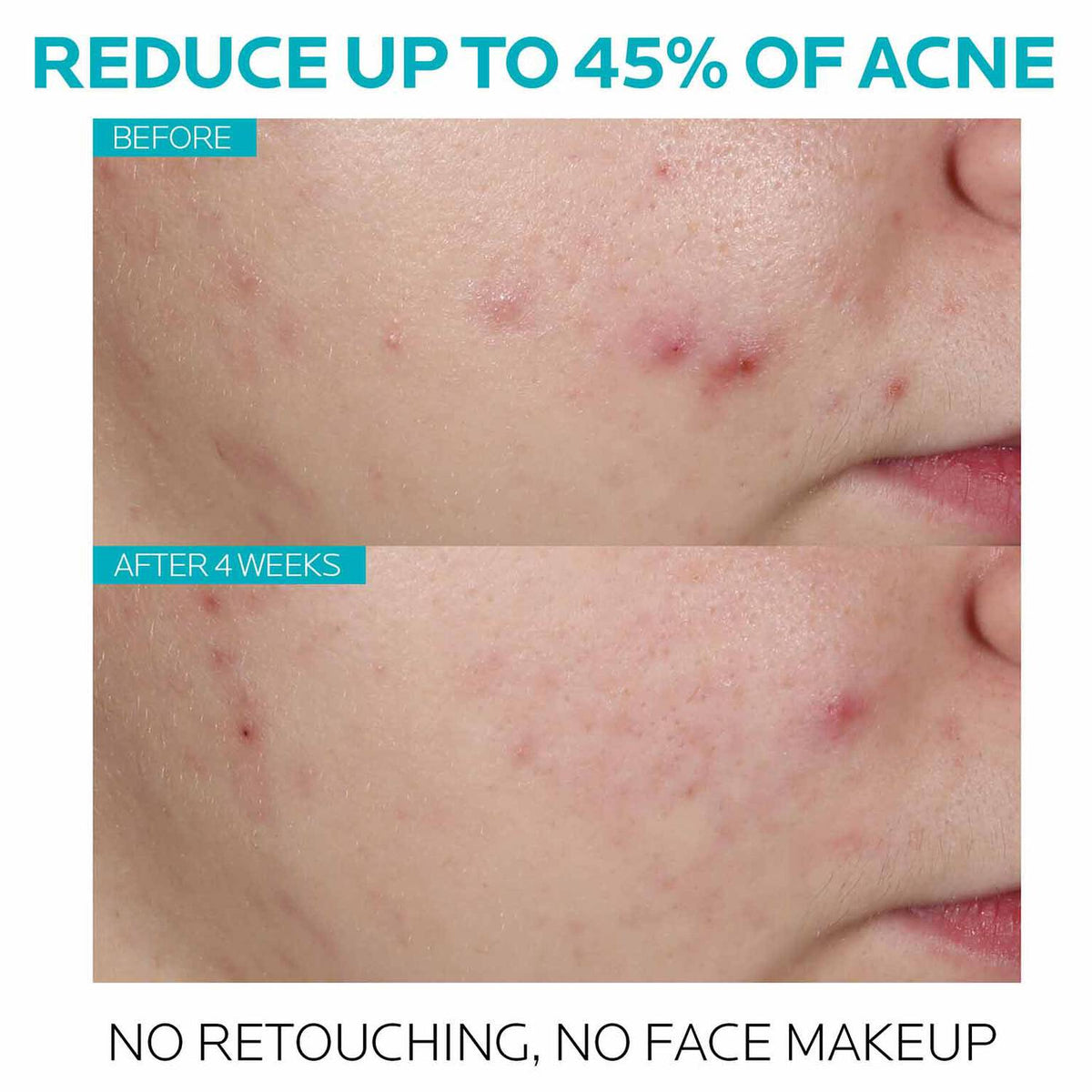 effaclar-salicylic-acid-acne-treatment-serum-b4 7_EffaclarSerum_After-45-days.jpg