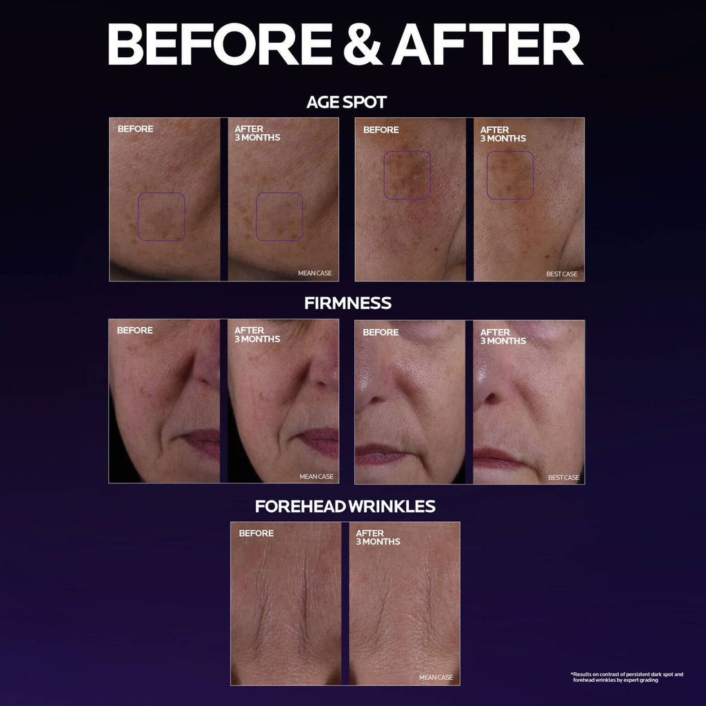 mela-b3-double-dose-discoloration-treatment-with-melasyltm-j0 MelaB3_DD_BTF_BeforeAfter_1500x1500_5.jpg
