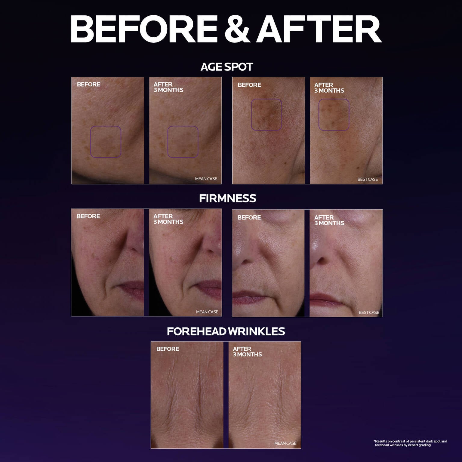 mela-b3-double-dose-discoloration-treatment-with-melasyltm-j0 MelaB3_DD_BTF_BeforeAfter_1500x1500_5.jpg